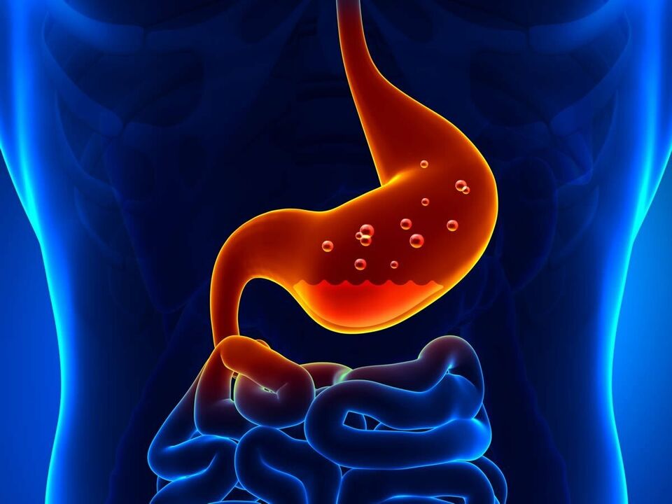 Gastritas yra uždegiminė skrandžio liga, kuriai reikia dietos